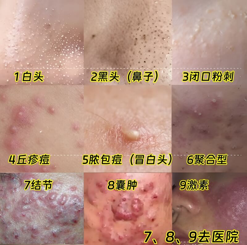 海阔天空祛痘精华液【适合哪些痘痘？】
